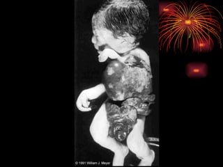 CONGENITAL MALFORMATIONS gogo.ppt cfmf   n