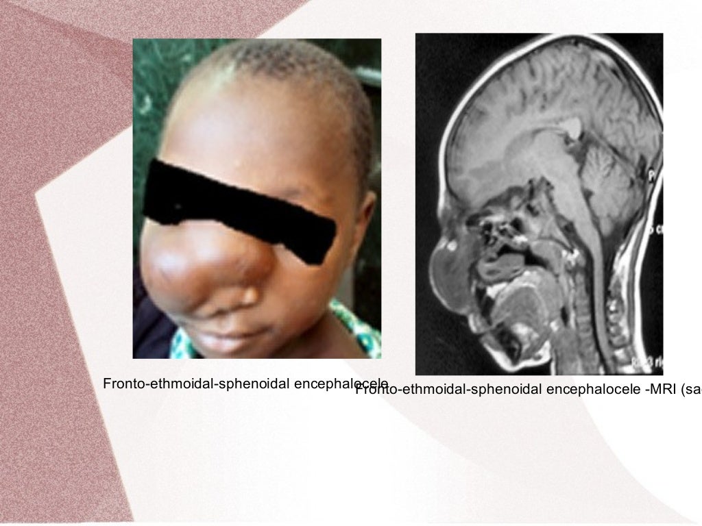 Congenital malformations of brain