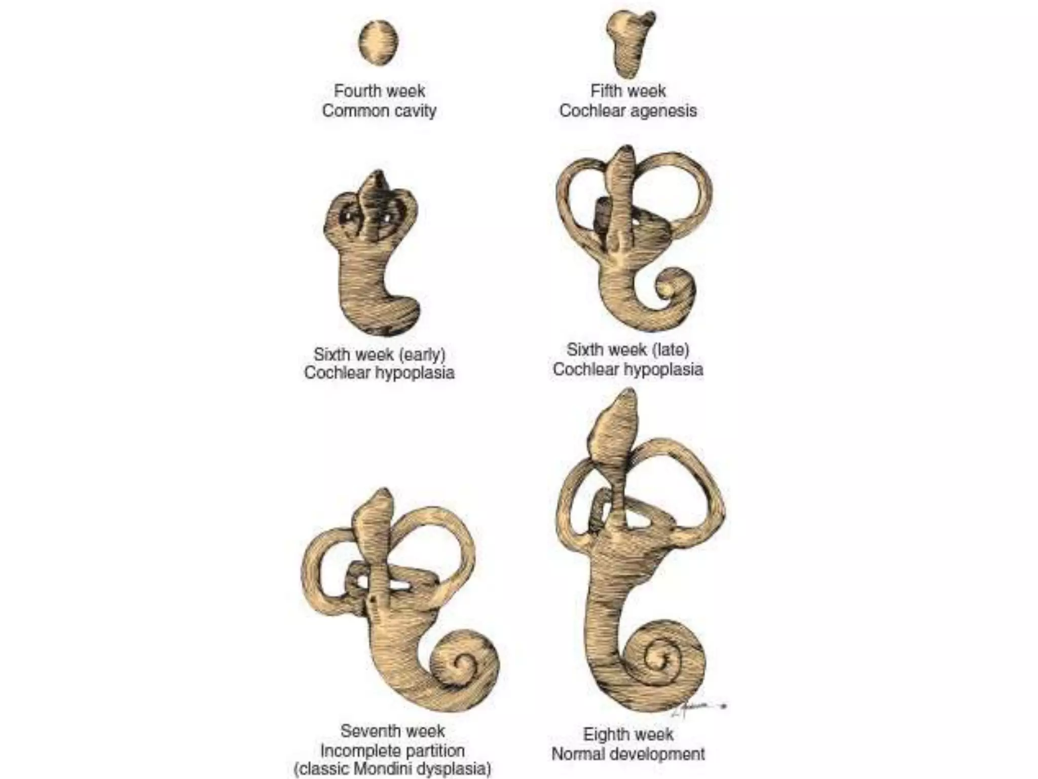 Congenital Malformations of Inner Ear.pptx