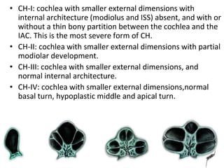Congenital Malformations of Inner Ear.pptx