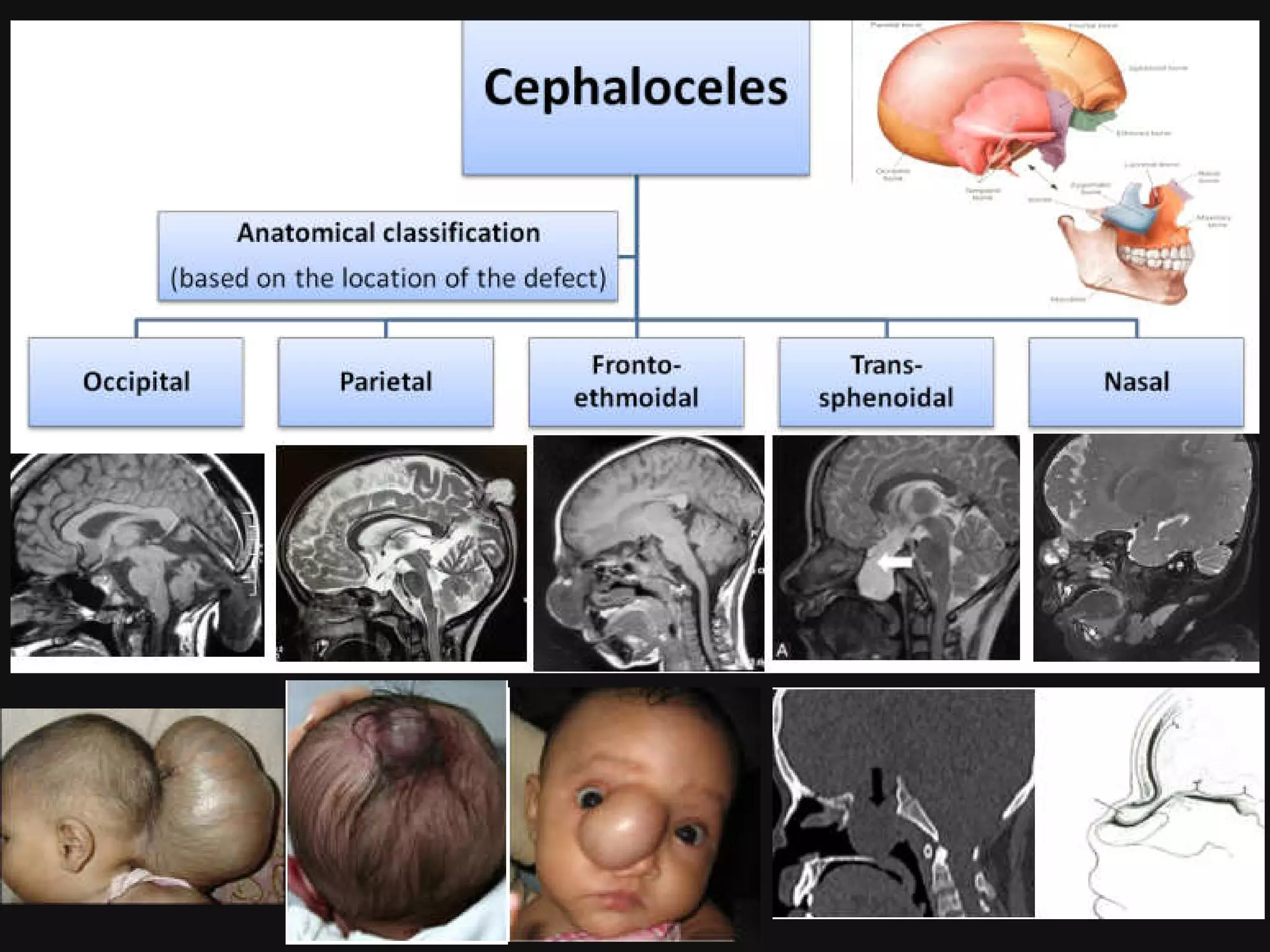 Congenital malformations of the brain abdul final | PDF