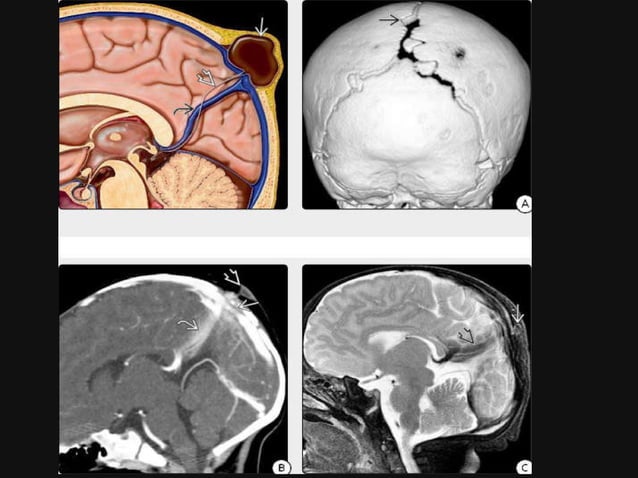 Congenital malformations of the brain abdul final | PDF