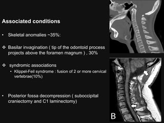 Congenital malformations of the brain abdul final | PDF