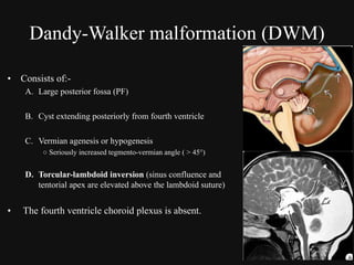 Torcular Inversion Congenital malformations of the brain abdul final | PDF