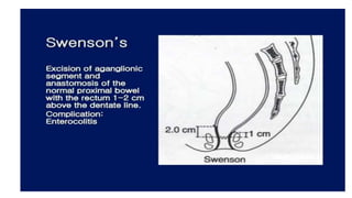 Congenital megacolon PPT