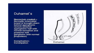 Congenital megacolon PPT