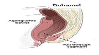 Congenital megacolon PPT
