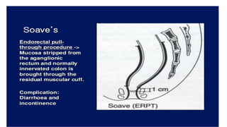 Congenital megacolon PPT