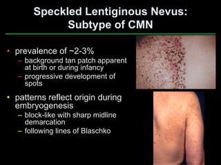 Congenital melanocytic nevi when to worry & when to treat | PDF