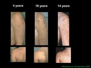 Congenital melanocytic nevi when to worry & when to treat | PDF