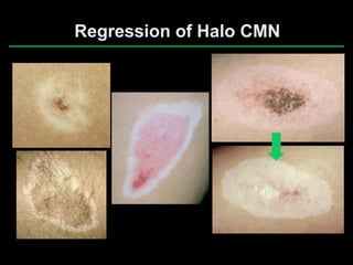 Congenital melanocytic nevi when to worry & when to treat | PDF