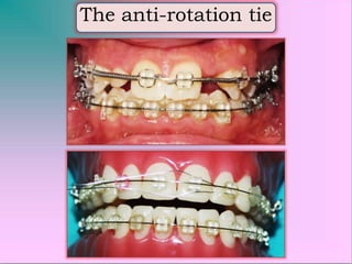 Congenital missing lateral incisors | PPTX