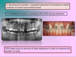 Congenital missing lateral incisors | PPTX