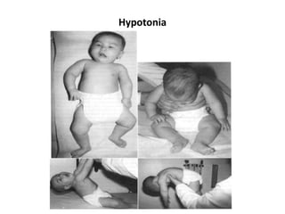 Hypotonia
 