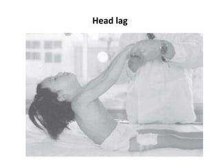 Head lag
 