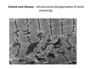 Central core disease - ultrastructural disorganization (Z-band
streaming).
 