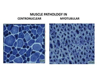 MUSCLE PATHOLOGY IN
CENTRONUCLEAR MYOTUBULAR
 