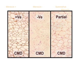 Merosin + Merosin - Somewhat
Merosin -
 