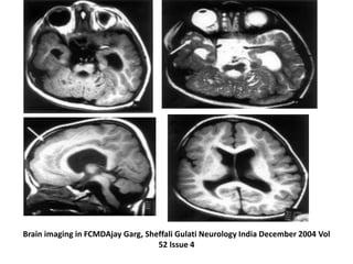 Brain imaging in FCMDAjay Garg, Sheffali Gulati Neurology India December 2004 Vol
52 Issue 4
 