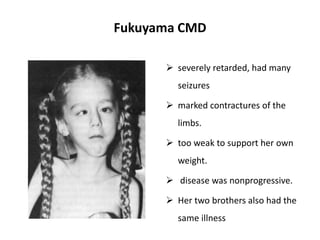 Fukuyama CMD
 severely retarded, had many
seizures
 marked contractures of the
limbs.
 too weak to support her own
weight.
 disease was nonprogressive.
 Her two brothers also had the
same illness
 