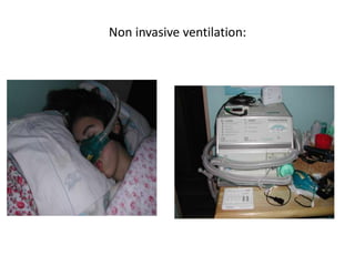 Non invasive ventilation:
 