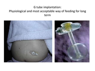 G tube implantation:
Physiological and most acceptable way of feeding for long
term
 