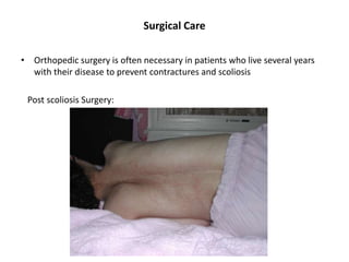 Surgical Care
• Orthopedic surgery is often necessary in patients who live several years
with their disease to prevent contractures and scoliosis
Post scoliosis Surgery:
 