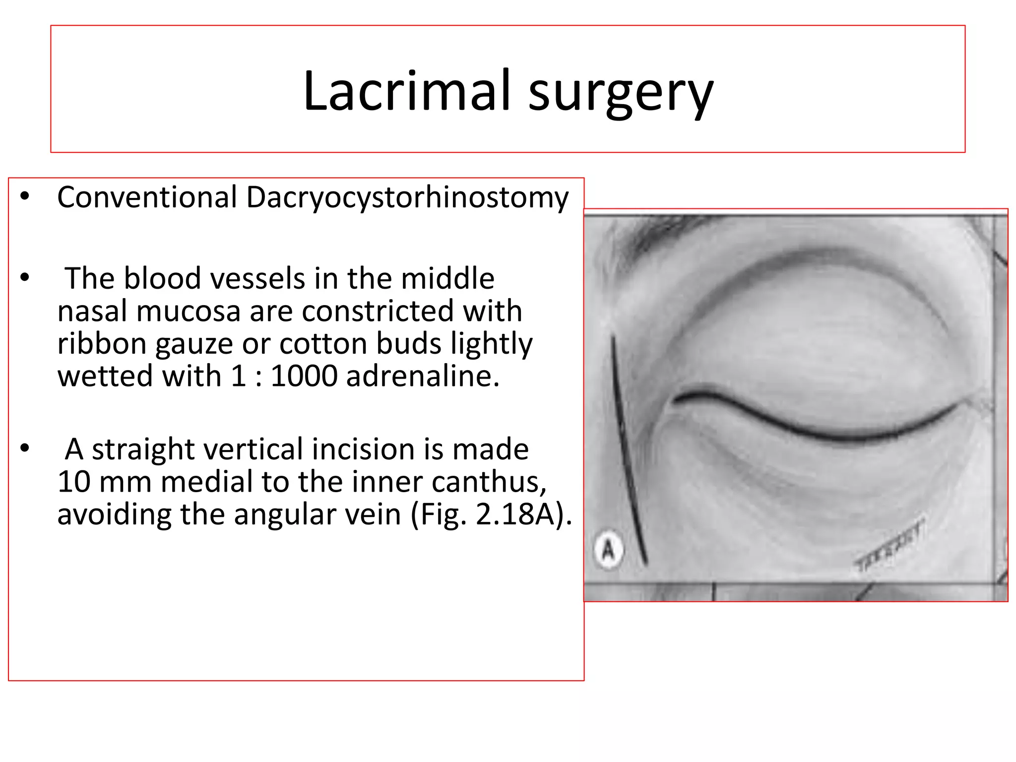 Congenital nasolacrimal duct obstruction | PPTX