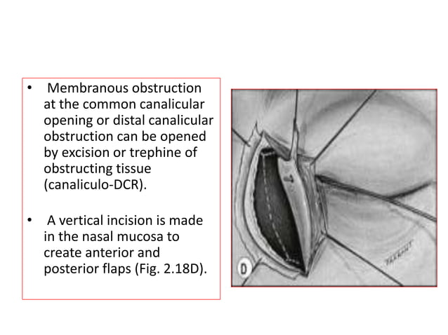 Congenital nasolacrimal duct obstruction | PPTX