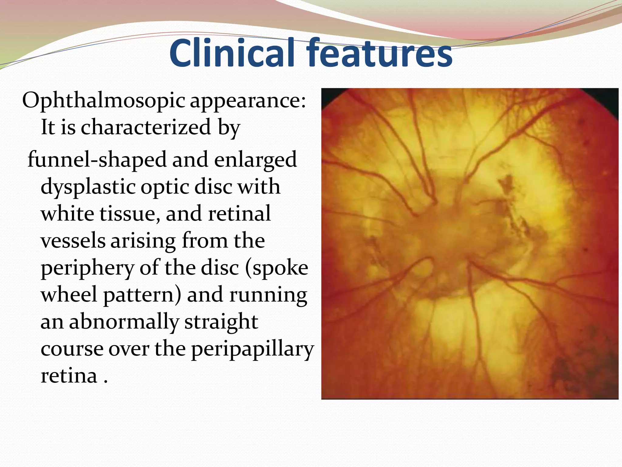 Congenital optic disc anomalies | PPTX