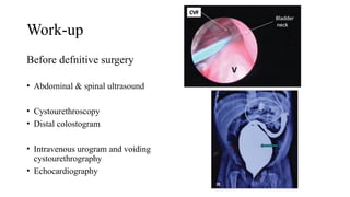 Congenital Pouch ColonNNNNNNNNNNN (2).pptx