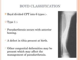 BOYD CLASSIFICATION
 Boyd divided CPT into 6 types :-
 Type 1 :-
 Pseudarthrosis occurs with anterior
bowing.
 A defect in tibia present at birth.
 Other congenital deformities may be
present which may affect the
management of pseudarthrosis.
 