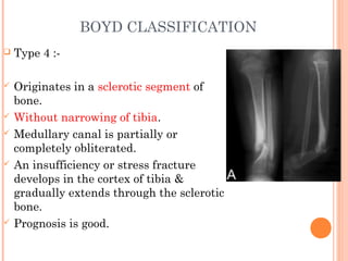BOYD CLASSIFICATION
 Type 4 :-
 Originates in a sclerotic segment of
bone.
 Without narrowing of tibia.
 Medullary canal is partially or
completely obliterated.
 An insufficiency or stress fracture
develops in the cortex of tibia &
gradually extends through the sclerotic
bone.
 Prognosis is good.
 