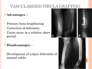 VASCULARISED FIBULA GRAFTING
 Advantages :-
 Primary bone lengthening
 Correction of deformity.
 Union occur in a relative short
period.
 Disadvantages :-
 Development of valgus deformity of
normal ankle.
 