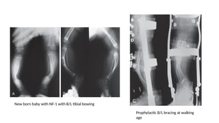 Tibia Baby CONGENITAL PSEUDO ARTHROSIS OF TIBIA-1.pptx