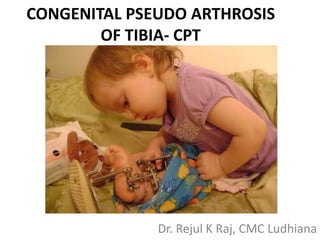 CONGENITAL PSEUDO ARTHROSIS
OF TIBIA- CPT
Dr. Rejul K Raj, CMC Ludhiana
 