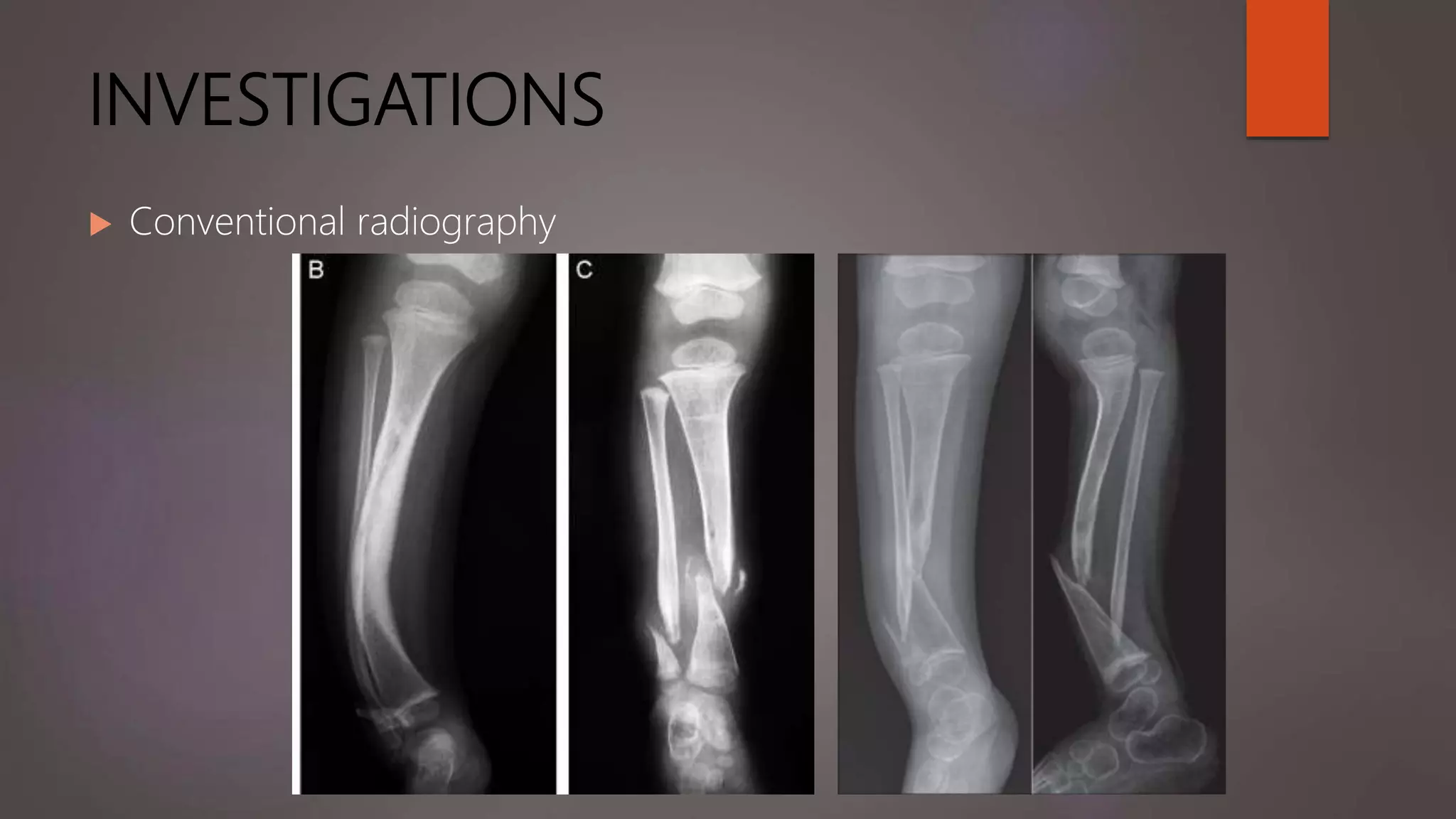 INVESTIGATIONS
 Conventional radiography
 