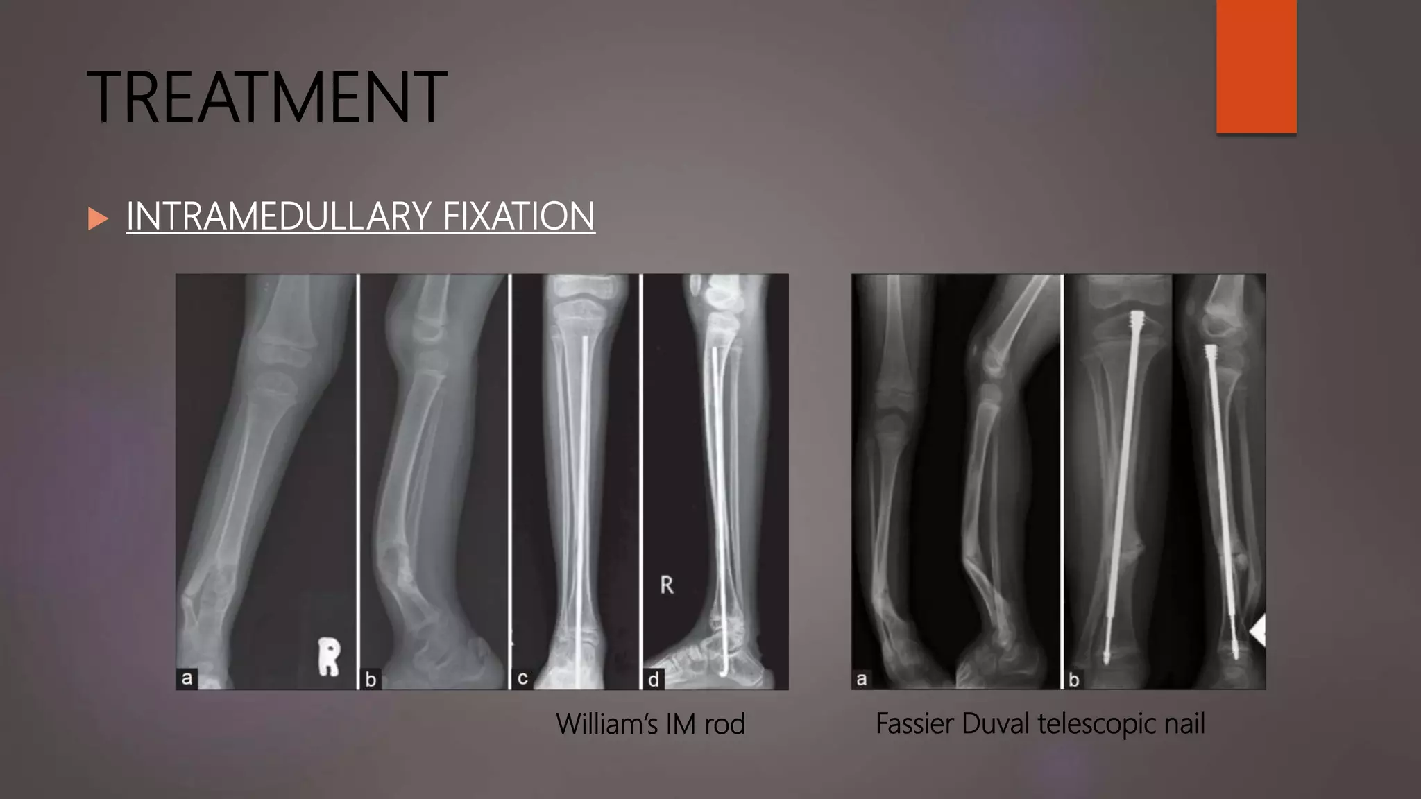 TREATMENT
 INTRAMEDULLARY FIXATION
Fassier Duval telescopic nailWilliam’s IM rod
 