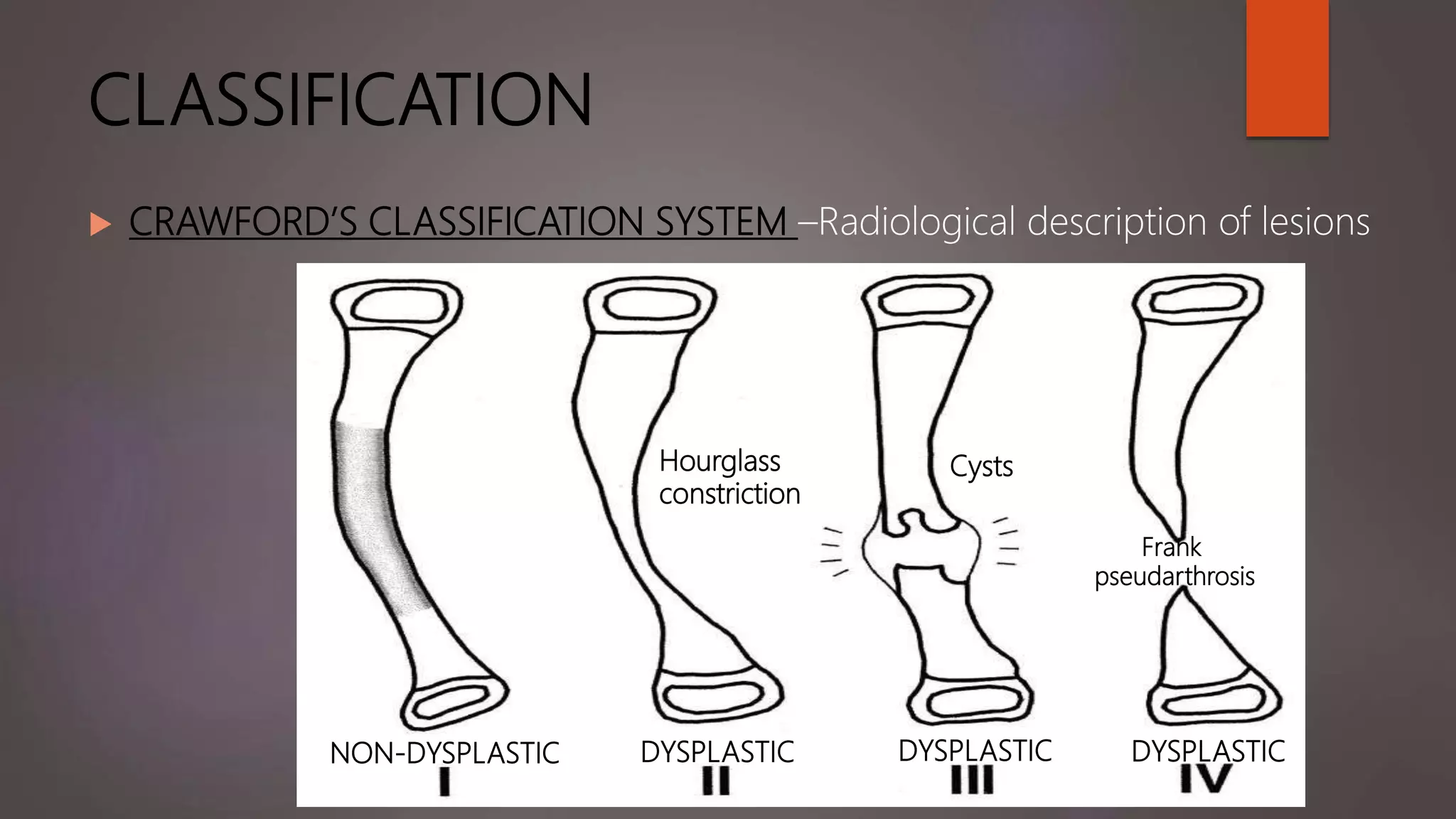CLASSIFICATION
 CRAWFORD’S CLASSIFICATION SYSTEM –Radiological description of lesions
NON-DYSPLASTIC DYSPLASTIC DYSPLASTIC DYSPLASTIC
Hourglass
constriction
Cysts
Frank
pseudarthrosis
 