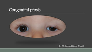 Congenital ptosis
By Mohamed Omar Shariff
 