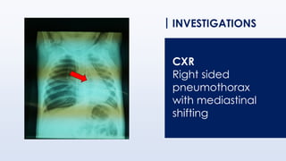 INVESTIGATIONS
CXR
Right sided
pneumothorax
with mediastinal
shifting
 