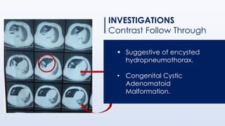 INVESTIGATIONS
Contrast Follow Through
▪ Suggestive of encysted
hydropneumothorax.
• Congenital Cystic
Adenomatoid
Malformation.
 