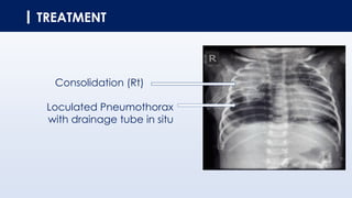 TREATMENT
Consolidation (Rt)
Loculated Pneumothorax
with drainage tube in situ
 
