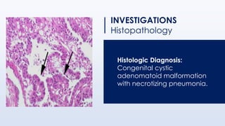 INVESTIGATIONS
Histopathology
Histologic Diagnosis:
Congenital cystic
adenomatoid malformation
with necrotizing pneumonia.
 