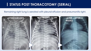 STATUS POST THORACOTOMY (SERIAL)
Remaining right lung is aerated with pleural effusion and pneumonitis right.
AFTER SURGERY AFTER REMOVAL OF TUBE LATER – AFTER 3
WEEKS
 