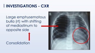 INVESTIGATIONS - CXR
Large emphysematous
bulla (rt) with shifting
of mediastinum to
opposite side
Consolidation
 