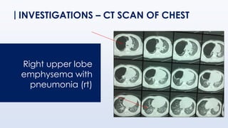 INVESTIGATIONS – CT SCAN OF CHEST
Right upper lobe
emphysema with
pneumonia (rt)
 