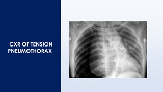 CXR OF TENSION
PNEUMOTHORAX
 