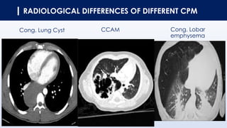 RADIOLOGICAL DIFFERENCES OF DIFFERENT CPM
CCAMCong. Lung Cyst Cong. Lobar
emphysema
 