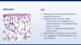▪ Background parenchyma will be
a good reference
▪ Fragmented alveolar walls
• If the acinar arrangement is
well remained, it is representing
pores of Kohn
• If not, it is representing acinar
destruction
▪ Mild fibrotic change can be seen
▪ Any degrees of inflammation can
accompany
HISTOLOGY CLE
 